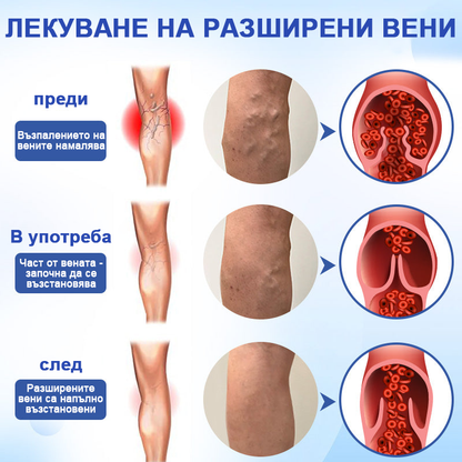 Veinhealing™ ✨Спрей за лечение на разширени вени✅ Клинично доказано, че елиминира разширените вени само за 7 дни!